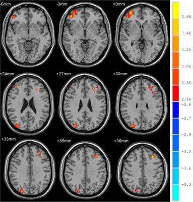 Resting-state functional magnetic resonance imaging-based identification of altered brain the fractional amplitude of low frequency fluctuation in adolescent major depressive disorder patients undergoing electroconvulsive therapy